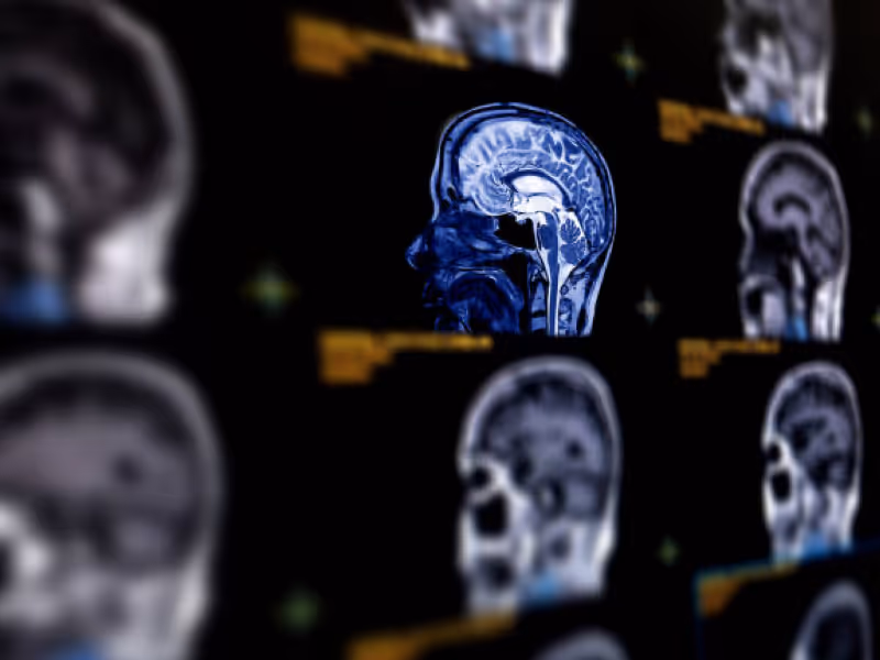 Brain MRI/MRA Scan