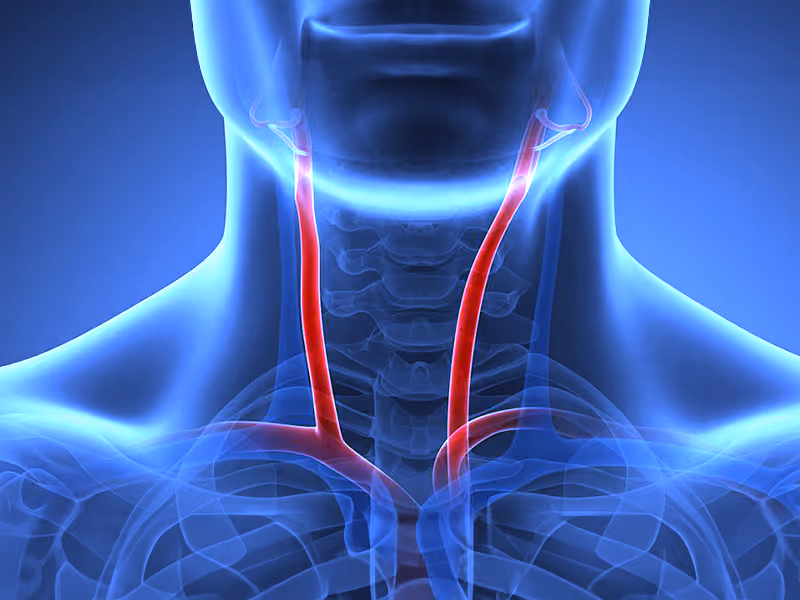Carotid Artery Ultrasound